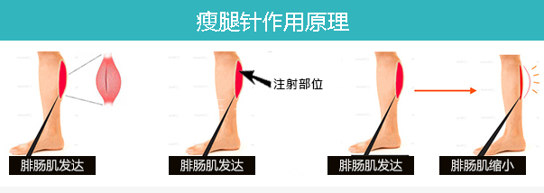 瘦腿示意图