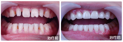 上海美莱全瓷牙受欢迎的原因
