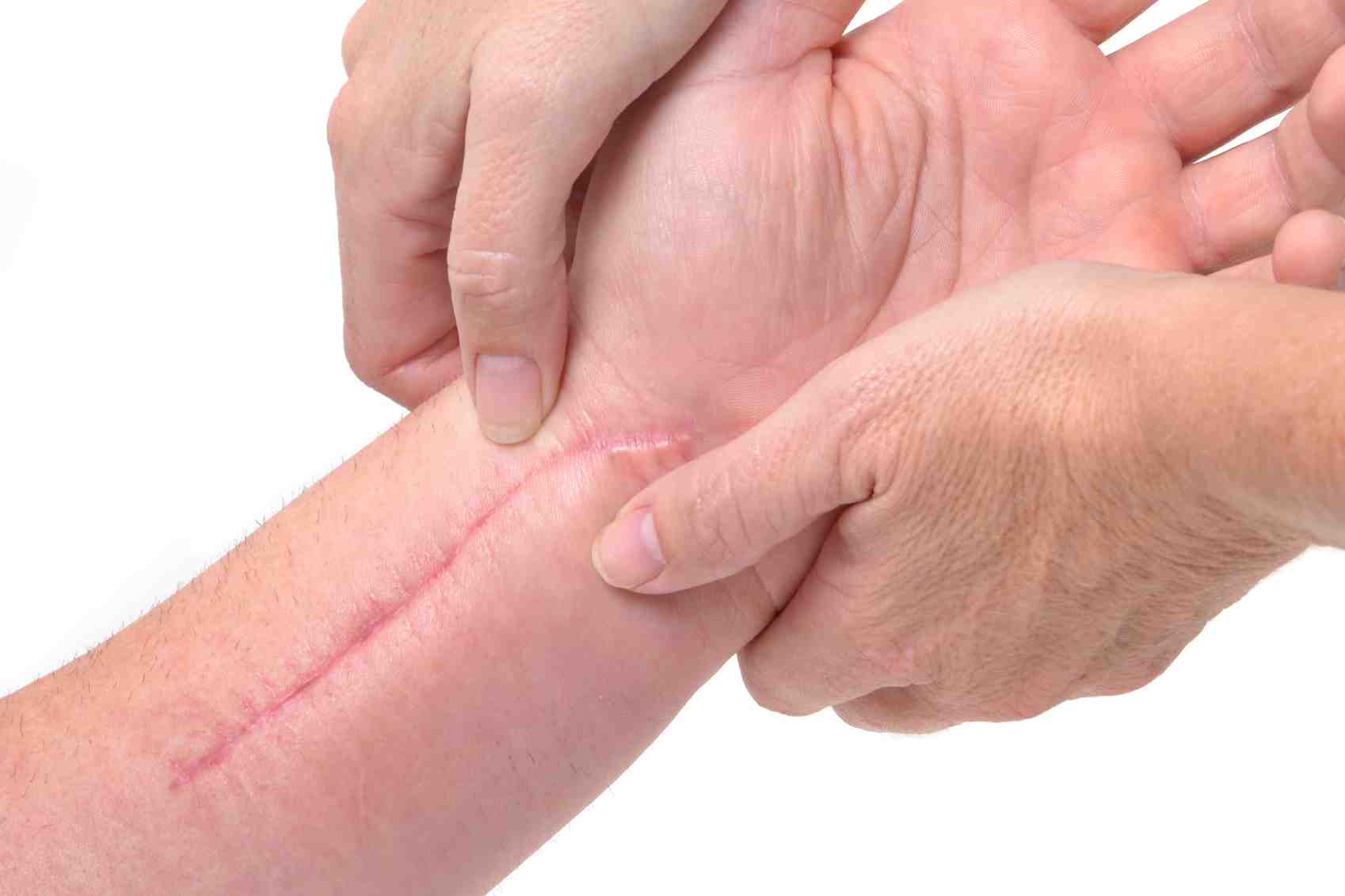 什么方式治疗凹陷性疤痕有效